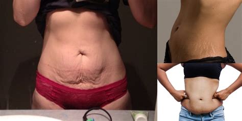 Veins coming out of my lower abs. Stretch Marks, Saggy Skin, & Excess Fat-OH MY! - Diary of ...