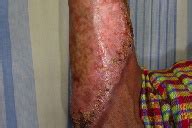 Scrofuloderma is a skin condition caused by tuberculous involvement of the skin by direct extension, usually from underlying tuberculous lymphadenitis.:335. Clinico-histopathological correlation and the treatment ...