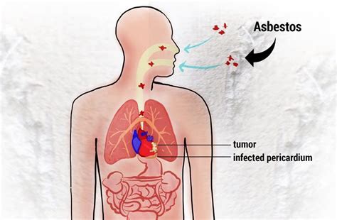 They probably don't know mesothelioma meaning. PB: mesothelioma meaning