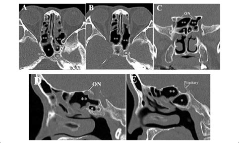 It is one of the three main planes of the body used to describe the location of body parts in relation to each other.axis. Axial, coronal and sagittal planes (from A to E) show that ...