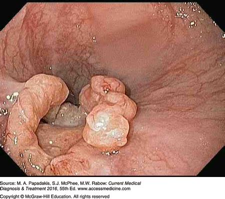 The endoscopie appearance of early hsv esophagitis is bullae (which are rarely seen) or discrete ulcers with a yellow rim of exudate or ulcer base, the note discrete punched out ulcers and several coalescent ulcers with raised margins and yellowish base. CMDT Media Library | AccessMedicine | McGraw-Hill Medical