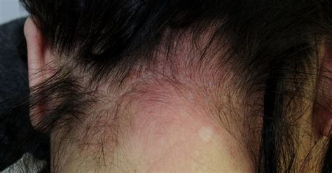 Dermatitis is characterized by inflammation, redness, itchiness and swelling of the skin around the eyelids, hair line, ears, neck or beard. How To Treat Allergic Reactions To Hair Dye