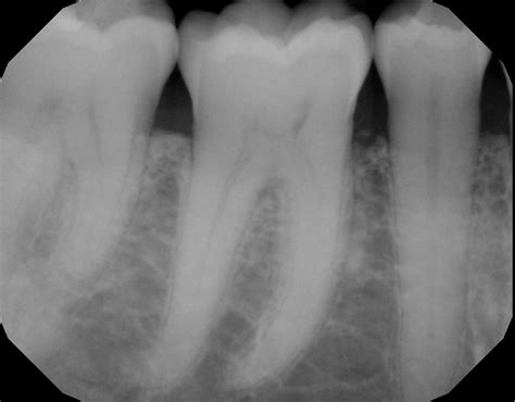 There are several types and stages of the disease, all of which start with an infection of the gums that can move into the bones and ligaments that support the teeth. Periodontal Disease Explained | Smile Philadelphian