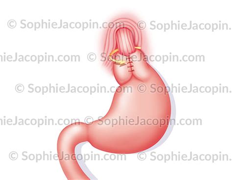 Orice problema de sanatate sau de activitate zilnica, ce maresc presiunea intraabdominala exercitata asupra peretele abdominal pot duce la o hernie, inclusiv HERNIE ABDOMINALE - Illustration Medicale & Didactique