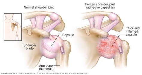 It is more common in people with diabetes, thyroid disease and in women over 40 years old. Frozen shoulder Disease Reference Guide - Drugs.com