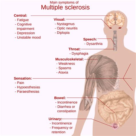 You may have a single symptom, and then go months or years without any others. 48 New Genetic Variants Linked to Multiple Sclerosis ...