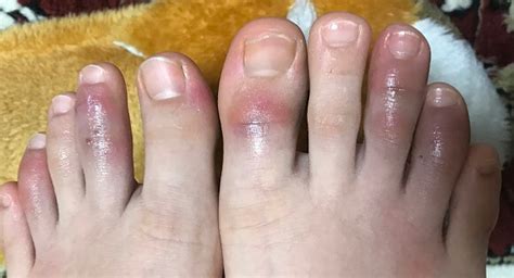 子供の手足のしもやけ劇的改善｜原因・対処法・皮膚科の薬 ...