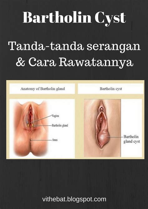 Sebelum haid, beberapa wanita mengalami gejala pms. Badan Sihat Hati Ceria: Tanda- Tanda Bartholin Cyst dan ...