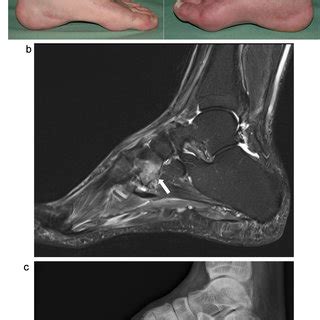 Die arthropathia neuropathica (= tabica) bei tabes dorsalis. (PDF) Die Rolle der radiologischen Bildgebung beim Charcot ...