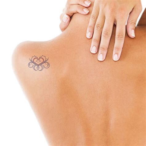 A laser tattoo removal treatment uses laser energy to break up and disperse tattoo pigment safely through the bodies' lymphatic system. Laser Tattoo Removal in Surrey - Bare Laser and Skin