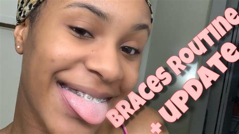 But these do not make a major difference in tooth color and may also contain abrasives which can damage ceramic brackets and make them more likely to stain. How I keep my teeth white with braces + update - YouTube