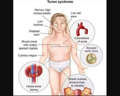 It can affect people in many different ways. Sindrom Turner : Penyebab - Gejala dan Pengobatan - IDN Medis