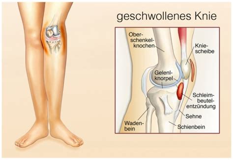 Gegen schmerzen und entzündungen kann ihr arzt ihnen medikamente verordnen, die als tabletten eingenommen oder auch direkt in das kniegelenk gespritzt werden können. Knieschwellung - Ursachen, Behandlung & Vorbeugung ...