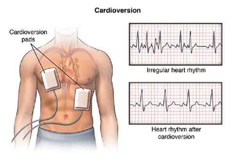 Corrente elettrica e corpo umano. Cardioversione elettrica: ripolarizzazione e ripristino ...