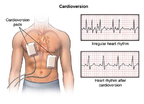 Definizione, ultime notizie, immagini e video dal dizionario medico del corriere della sera. Cardioversione elettrica: ripolarizzazione e ripristino ...