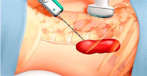 Chassin c., tourneur e., bens m., vandewalle a. Biópsia Renal - Bestane Urologia