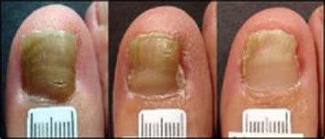 Permanently, so it never grows back (and then you won't have a toenail anymore), or you can let it grow back in. Toenail Fungus Laser Treatment in Maryland | Lakeforest ...