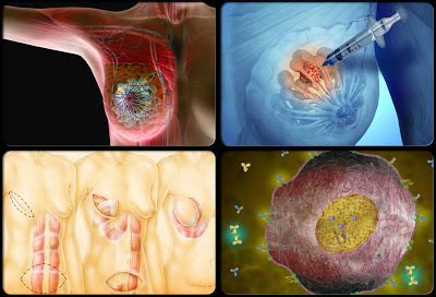 Kanser payu dara merupakan kanser atau barah yang paling kerap meyerang wanita. Duniaku dan Ceritaku©: KANSER PAYUDARA PEMBUNUH GANAS DAN ...