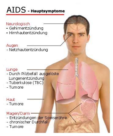 Dazu zählen weitere infektionen (koinfektionen). AIDS