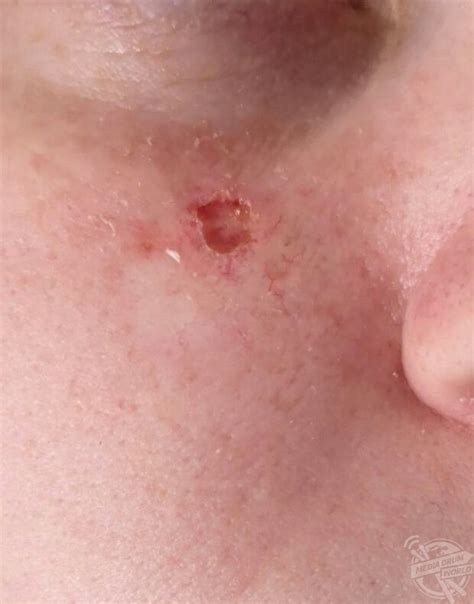 You'll usually see keratoacanthoma on. Chickenpox Scar Turned Into Skin Cancer Nearly Three ...