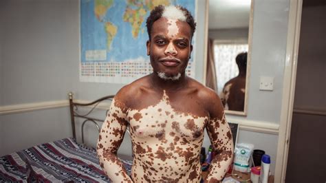 Sorry if i caused you any offense though. My Vitiligo is Disappearing - But I Don't Want It To ...