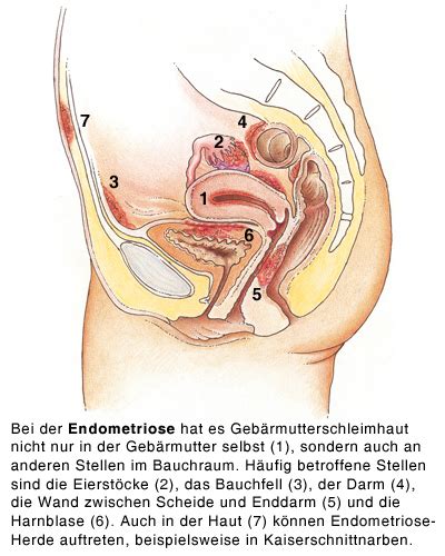 Mindestens drei entzündungen des mittelohres innerhalb eines halben jahres oder mindestens vier in einem jahr. Gutartige Tumoren der weiblichen Geschlechtsorgane - eesom ...