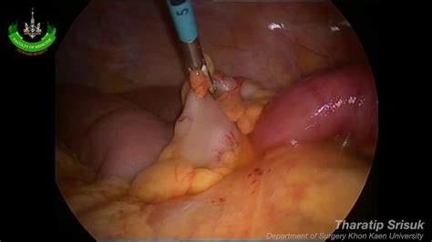 Use of gems to convert payment intestinal obstruction k50813 crohn's disease of both small and large intestine with fistula k50814 crohn's disease of both small and large. Laparoscopic Lysis of Adhesion: Small Intestinal ...