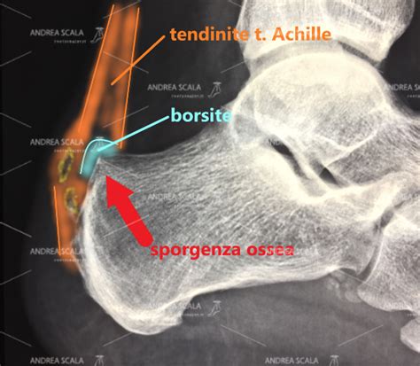 Anatomia il tendine d'achille è l'estensione di due muscoli. HAGLUND E TENDINE D'ACHILLE. STACCARE IL TENDINE DAL ...