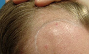 Roseville Hair Transplant Before and After Photos ...