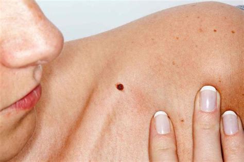 Qual è il nevo intradermico della pelle?