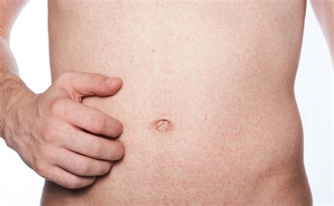 Lässt sich ein knoten tasten, kommen immer bedrohliche gedanken auf. Ausschlag am Bauch