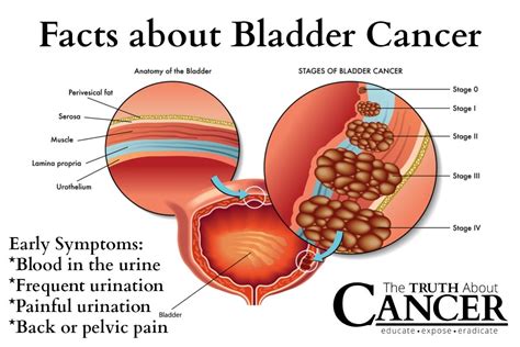 Because of this, the doctor may take samples from many different parts of the bladder, especially if cancer is strongly suspected but no tumor can be seen. Bladder cancer - Signs, Symptoms and Causes | Home Remedies