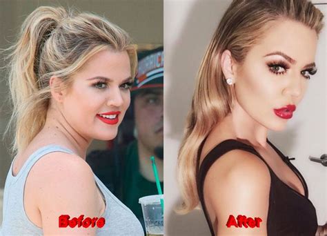 Kardashian sisters have a massive presence inside and outside of social media. Khloe Kardashian before/after BOTOX | Botox, Khloe ...