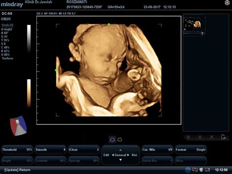 Ultrasound/scan 4d update & info. Poliklinik Fasya Bukit Beruang, Melaka: Scan 3d 4d melaka ...