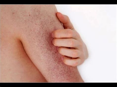 In the meantime, you might use any of the various products available to help improve the appearance of the skin. Keratosis Pilaris Cream, Best Treatment For Keratosis ...