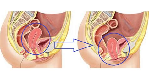 Ingin tahu apa tanda awal kanser rahim tahap 1? Tanda Tanda Rahim Jatuh : Cara Menaikkan Peranakan Yang ...