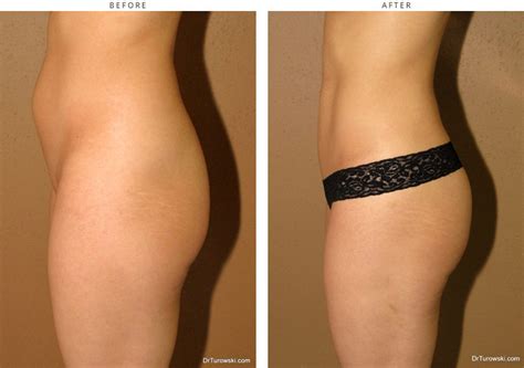 Brazilian buttock lift with fat grafting or lipofilling is an operation to restore or reshape the buttocks to provide a fuller, firmer uplifted, buttocks or autologous fat transfer aft for brazilian buttock lift, provides a long lasting or permanent improvement. Pussy Rejuvenation 75177 | Brazilian Buttock Lift - Before