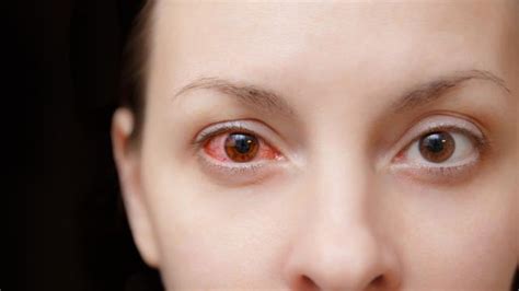 7 penyebab katarak di usia muda dan pencegahannya. 6 Penyebab Mata Merah yang Harus Diwaspadai, Jangan Anggap ...