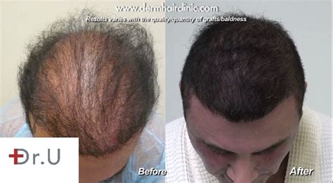 Hair transplant & restoration in los angeles. Hair Transplant Cost Methods- DermHair Clinic Los Angeles ...