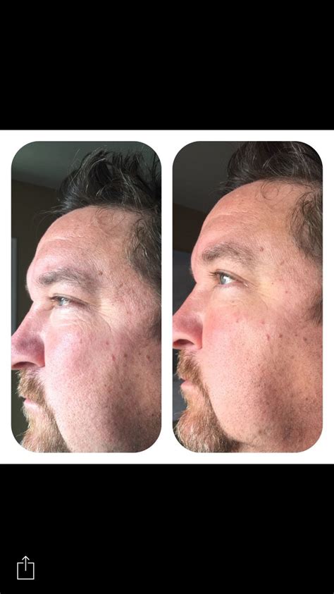 In this masc minute, jamie talks to you about the hair growth factor treatment serum from nanogen. Nerium's newest product-Eye Serum. This is a before and ...