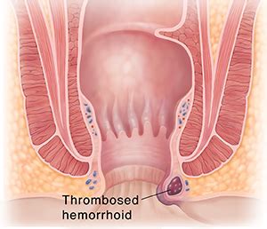 Hemorrhoids on the inside are called internal hemorrhoids, and those on the outside are called external hemorrhoids. Thrombosed Hemorrhoids | Saint Luke's Health System
