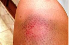 bruising thighs bruises etopical
