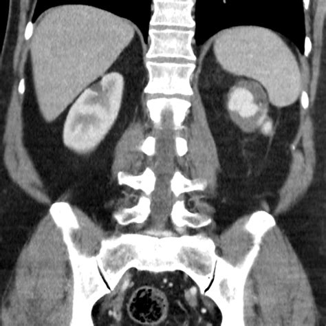 If the lesion is depicted only on enhanced ct, delayed scanning. Image | Radiopaedia.org