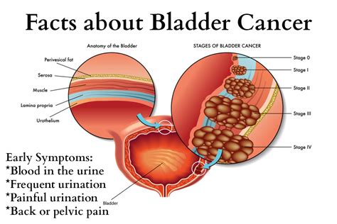 Prostate cancer is the second most common cancer among american men. Dr. Vishal Vig :: bladder Cancer | Best urologist in ...