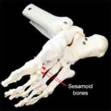 Sesamoiditis - pain under the foot explained ...