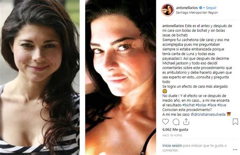 La actriz antonella ríos se sumó a la app unlock, donde comparte su más osadas fotos. Antonella Ríos muestra el antes y el después de su cirugía ...