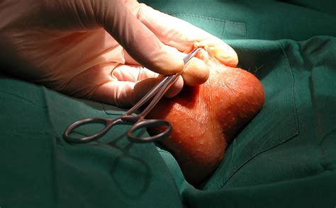 We did not find results for: Vasectomy Blog - Coole Surgery