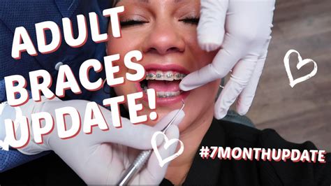 Using these braces tips and braces hacks, we can make your braces journey more memorable and favorable. ADULT BRACES UPDATE | RUBBER BANDS | Full Tightening ...