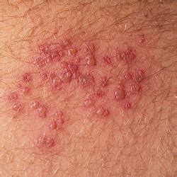 People with symptoms may have painful blisters or sores at the site of infection (2,3). herpes genitalis male - pictures, photos