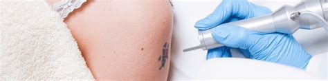 If you get laser hair removal from us, tattoo removal feels about the same. Lasert Tattoo Removal | Chrysalis Day Spa | Hot Springs ...